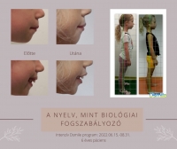 Fogszab&aacute;lyoz&aacute;s &eacute;s &aacute;llkapocspoz&iacute;cion&aacute;l&aacute;s izmokkal